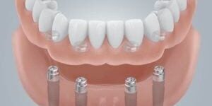 Protesi-su-impianti-300×230