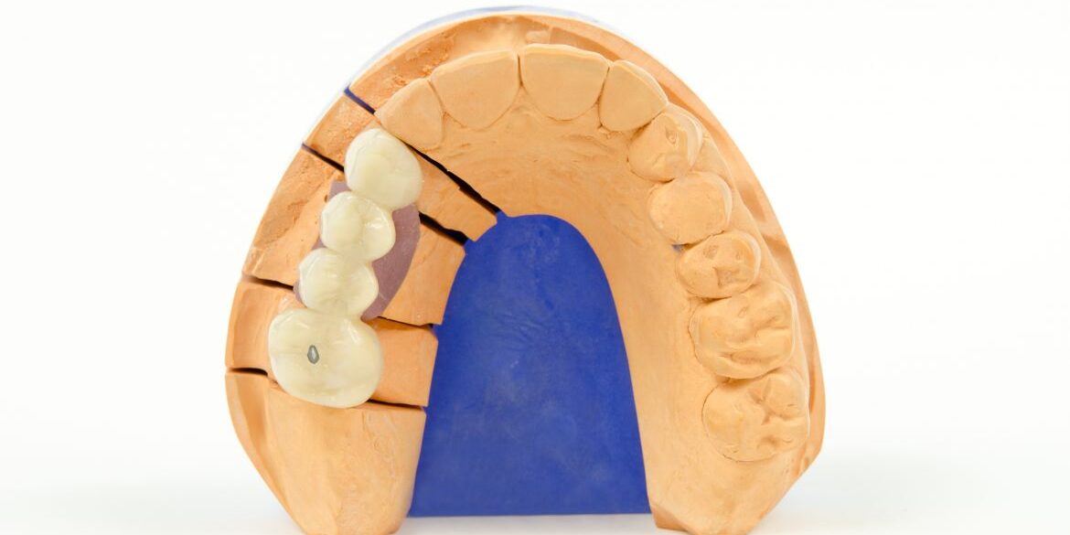 denti-provvisori-corone-Croazia-1170×659